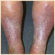 Diabetic Dermatitis